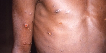 کناڈا میں منکی پوکس سے متاثرہ افراد کی تعداد 700 ہوگئی